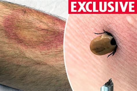 Super tick carrying Lyme disease to invade UK this summer | Daily Star