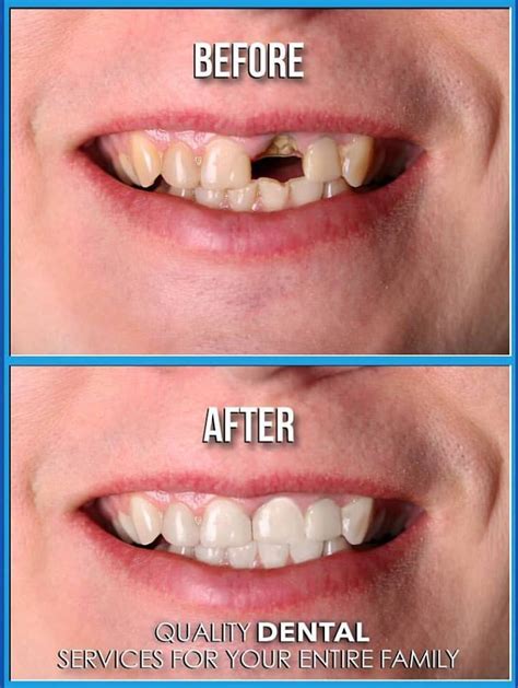 Dental Implants Pictures Before & After Photos of Dental Implants