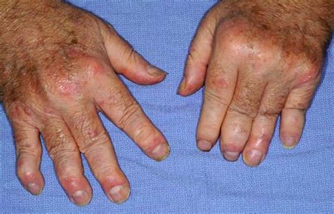 Psoriatic Arthritis - Causes, Symptoms, Diagnosis, Diet & Treatment