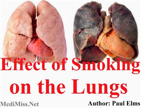 Effect of Smoking on the Lungs - MediMiss