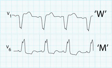 Left Bundle Branch Block (LBBB) • LITFL • ECG Library Diagnosis