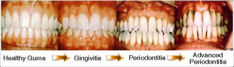 Periodontitis Treatment - What you need to know