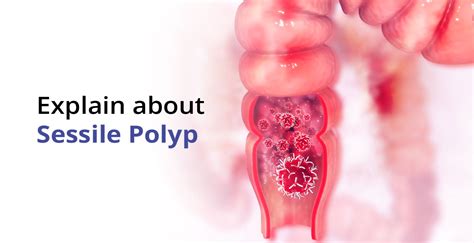 Sessile Polyp Symptoms, Diagnosis & its Treatment | Birla Fertility & IVF