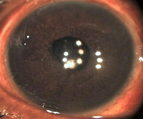 Post-operative initial. Day 3 post surgery: status after scleral... | Download Scientific Diagram