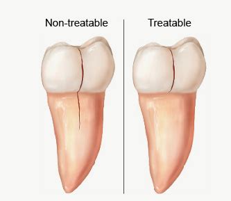 Cracked Teeth | Endodontic Associates Dental Group - root canal doctors in Sacramento, Elk Grove ...