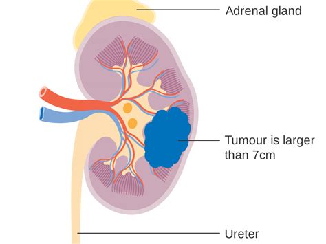 kidney cancer diagnosis Archives - Philadelphia Urology Associates