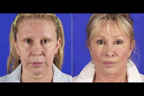 Mid Facelift Beverly Hills, CA | Dr. Frankel