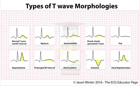 ECG Educator Blog : Types of T-waves