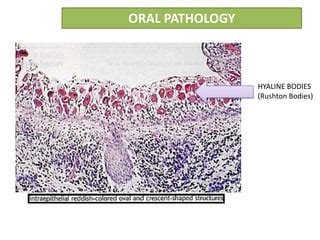 Periapical Cyst Histology