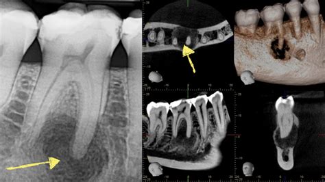 Periapical Abscess Radiograph