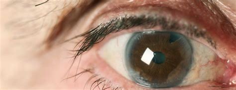 Immature Cataract: Meaning, Symptoms And Tips To Manage