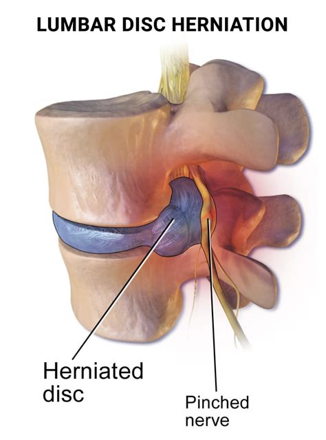 Does Pregnancy Cause Herniated Disc | New York Pain Care