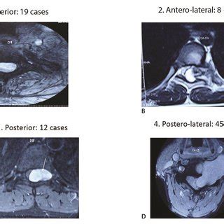 Axial location of the spinal cord tumor as observed in MRI scans. ( )... | Download Scientific ...