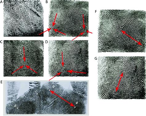 Ulnar Loop Vs Radial Loop Fingerprint