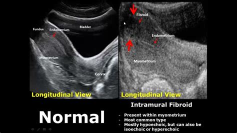 Intramural, Sonography, Cervix, Uterus, Ultrasound, Pathology, Medical, Health, Tips