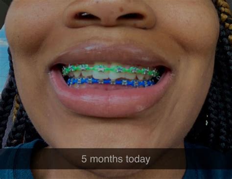 Pin on Cute braces colors