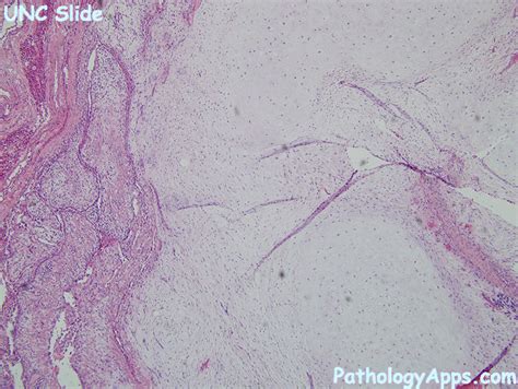 hamartoma lung histology