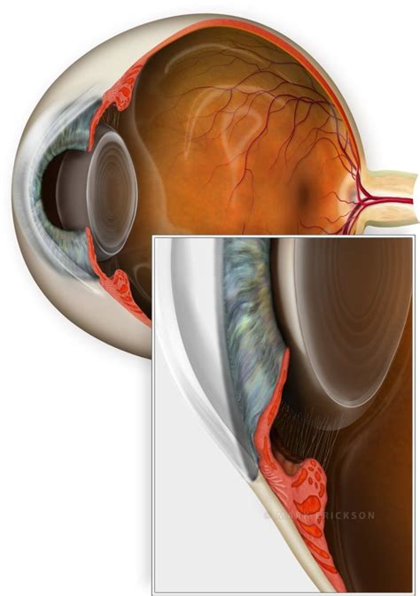 Narrow angle anterior chamber patient education illustration