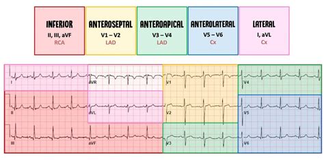 STEMI & NSTEMI: A Nurse's Comprehensive Guide | Health And Willness