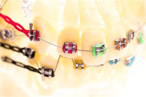 What Does A Broken Bracket Look Like? - Smile Credentials