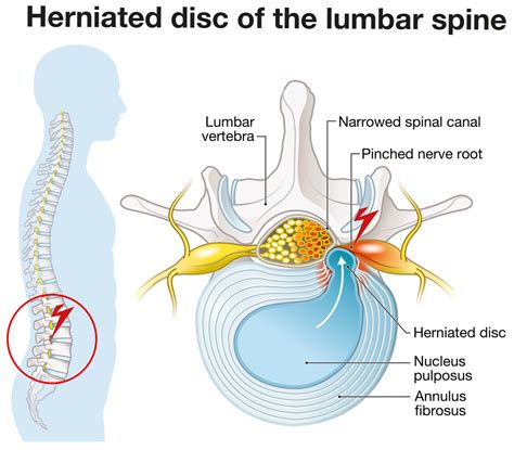 Treatment for Herniated Disc | Premia Spine Blog