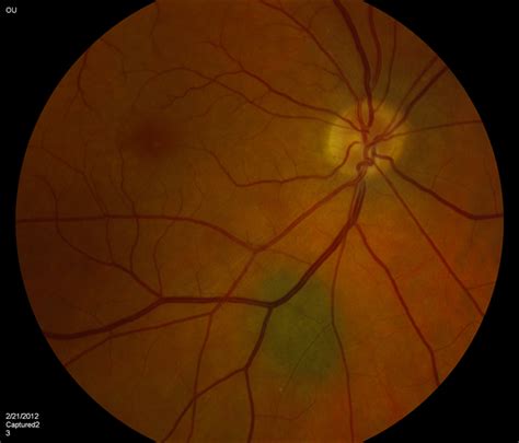 Benign Choroidal Nevus - Retina Image Bank