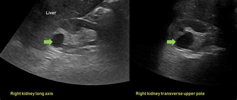 Ultrasound features of Kidney Cysts - Renal Fellow Network