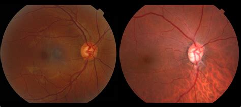 What Causes Nerve Damage In Eyes - Infoupdate.org