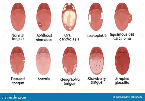 Disease Of The Tongue Cartoon Vector | CartoonDealer.com #78947545