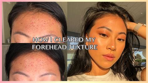 HOW TO REALLY GET RID OF FOREHEAD ACNE / TEXTURE | Christine Le - YouTube