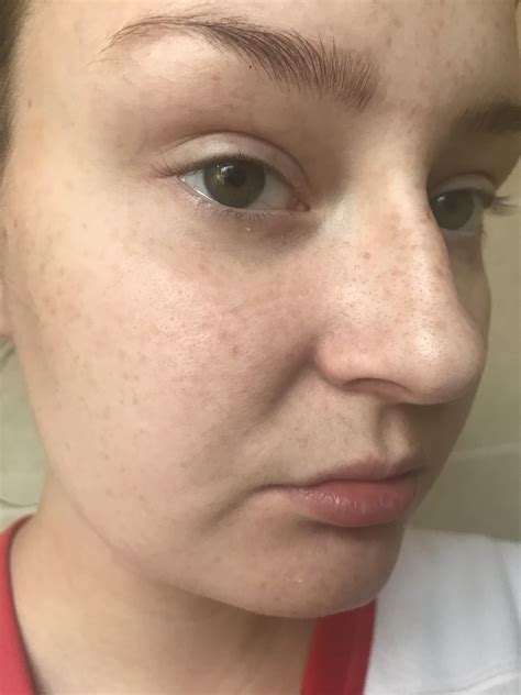 [Skin Concerns] Pigmentation on my face? : r/SkincareAddiction