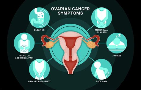 Ovarian Cancer Symptoms Infographic 3107732 Vector Art at Vecteezy