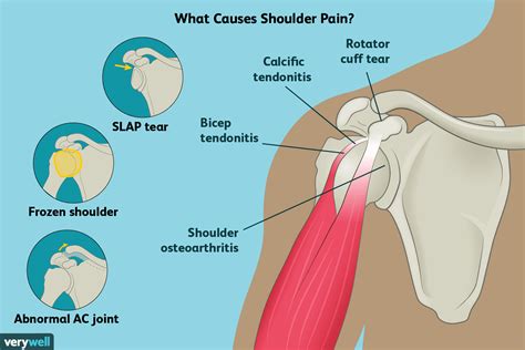 Causes of Shoulder Pain and Treatment Options