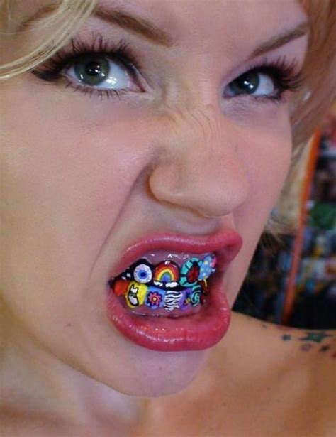 50+ Best Braces Colors For Girls Gif