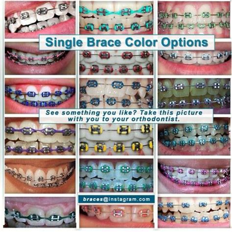 68 best images about ||Braces colors|| on Pinterest