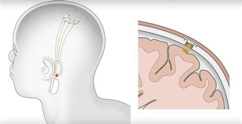 Musk's Neuralink brain chip could add a layer of 'Super-Intelligence'