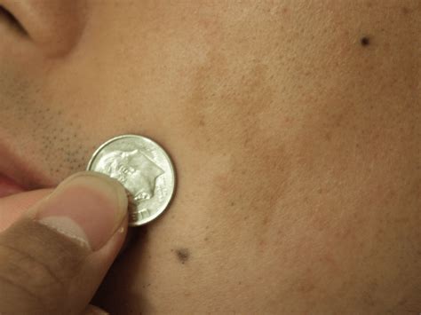 What Are Birthmarks And Why Do We Get Them?