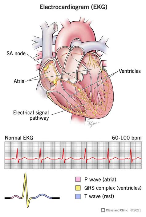 Normal Ecg Vs Heart Attack Ecg