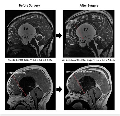 MRI brain+/-contrast showing the arachnoid cyst (AC), enlarged lateral ...