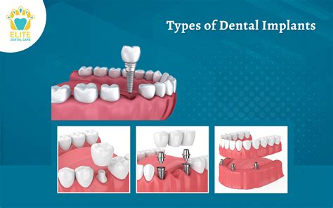 Types of Dental Implants | Elite Dental Care