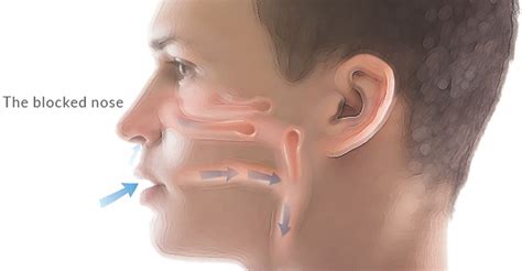 The Blocked Nose | Sinus Surgical Treatment Brandon Hitchcock