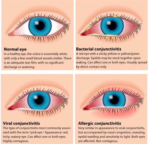 Pink Eye (Conjunctivitis) | Granthealth.org