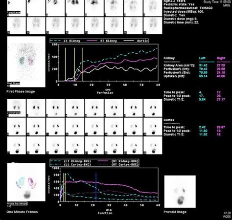 Abnormal 99m Tc Mag-3 renal scan showing diminished differential renal ...