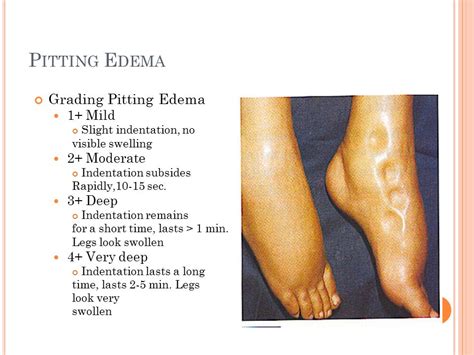 Pitting Edema Levels