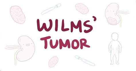 Wilms Tumor Staging - CancerOz