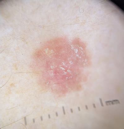 Scaly lesion on forearm | MDedge Dermatology