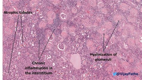 Chronic Pyelonephritis Histology