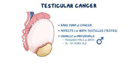 Testicular Cancer: Symptoms, Stages, Diagnosis, Risk, 45% OFF