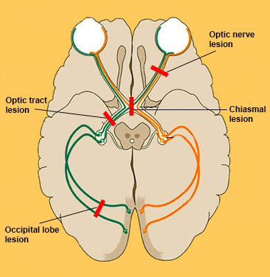 Visual Pathway Lesions : Anatomy : The Eyes Have It