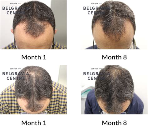 Hair Growth Success Story: "I have noticed an improvement after only 3 months"